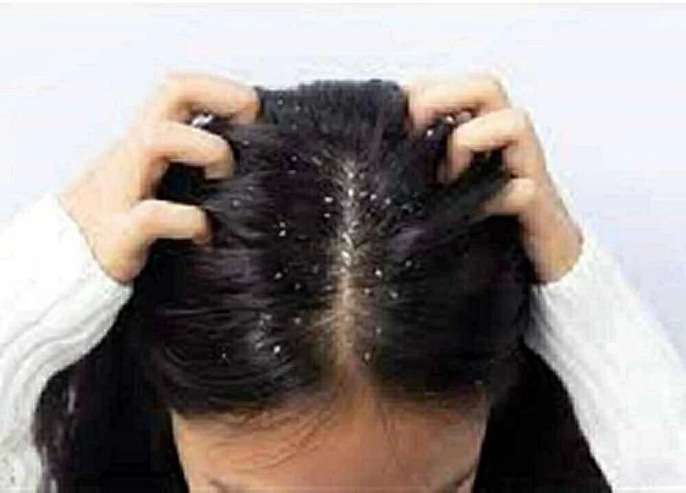 تحذير من الإفراط فى التنظيف.. طرق فعالة لعلاج القشرة الدهنية