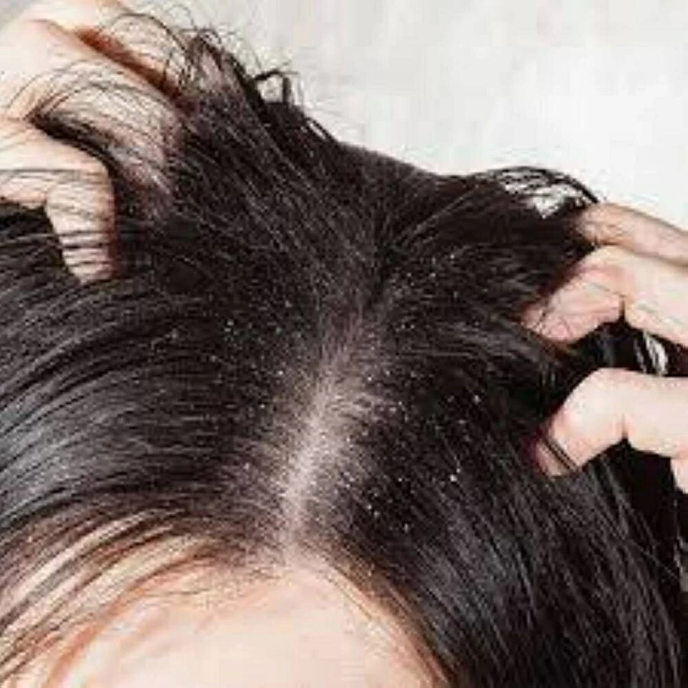 حل مضمون وفعال.. 5 نصائح للتخلص من قشرة الرأس نهائياً